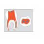 Fresa Dental Endodoncia Redondo H1SNL,  Fresas Dentales para Endodoncia 5 Unidades
