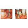 Fresas Odontosección-Diamante GSD1, Fresas Dentales para Cirugía e Implantes 3 Unidades
