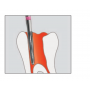 Cónica extra larga, Fresas Dentales para Endodoncia 5 Unidades H152