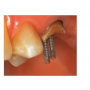 Llave Tubular 61 Dental para Clínicas Dentales 3 Unidades