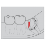 Odontosección-Diamante Osteotomias G254, Fresas Dentales para Cirugía e Implantes 3 Unidades